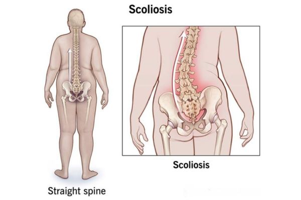 Scoliosis Treatment in Mumbai by Dr. Vishal Kundnani