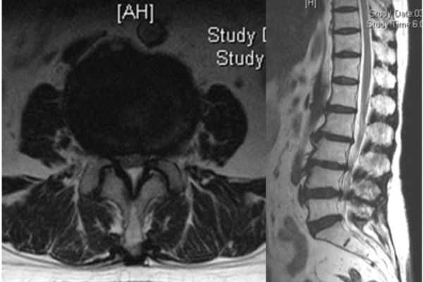 Diagnosis of Spinal Stenosis by Dr. Vishal Kundnani in Mumbai