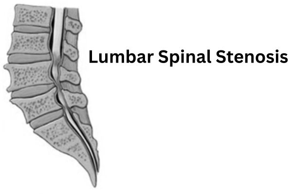 Lumbar Spinal Stenosis treated by Dr. Vishal Kundnani in Mumbai