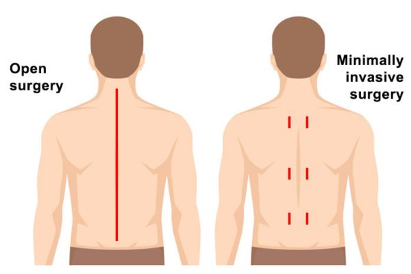 Minimally invasive spine surgery in Mumbai by Dr. Vishal Kundnani
