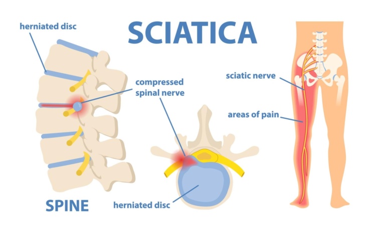 Sciatica Treatment in Mumbai by Dr. Vishal Kundnani