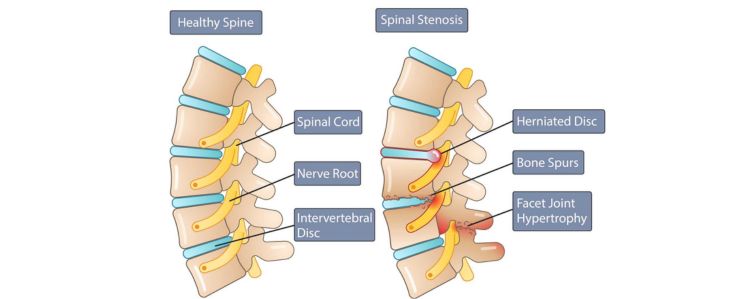 Spinal Stenosis Treatment in Mumbai by Dr. Vishal Kundnani