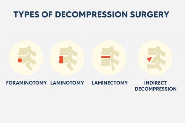 Types of Decompression Surgery treated by Dr. Vishal Kundnani in Mumbai