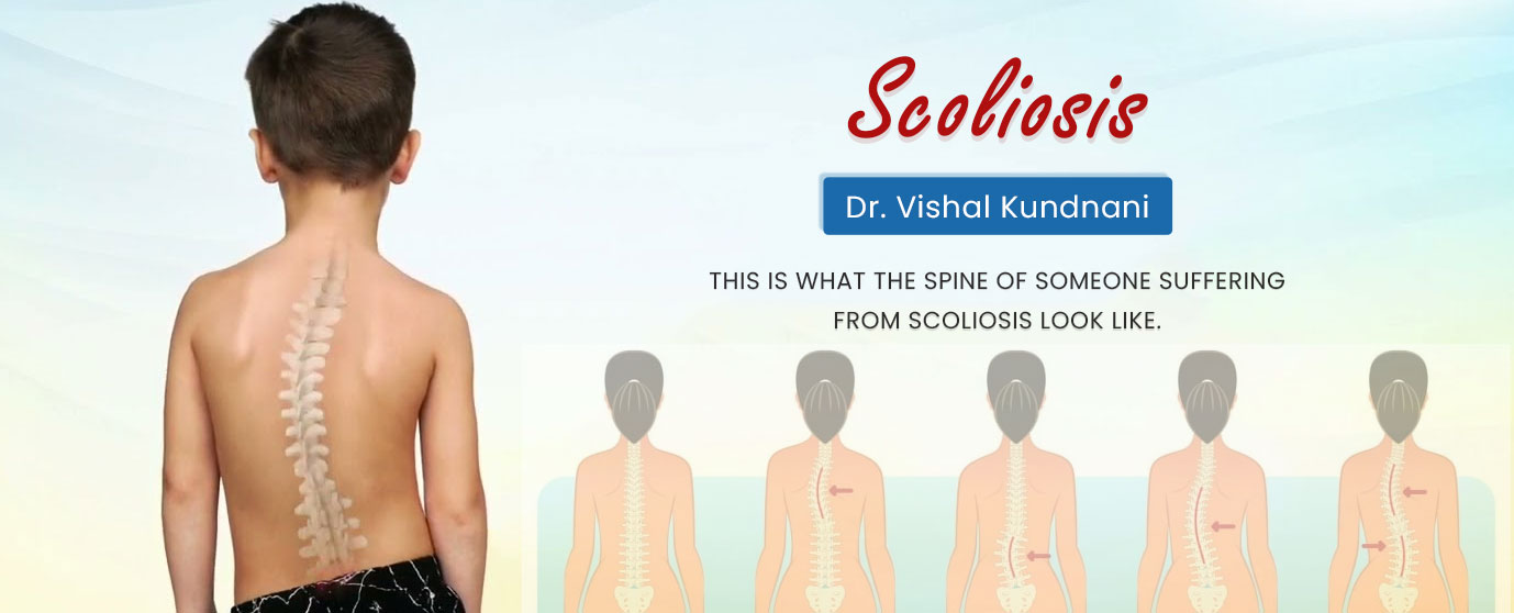 Scoliosis - Dr. Vishal Kundnani - Spine of a Person with Scoliosis