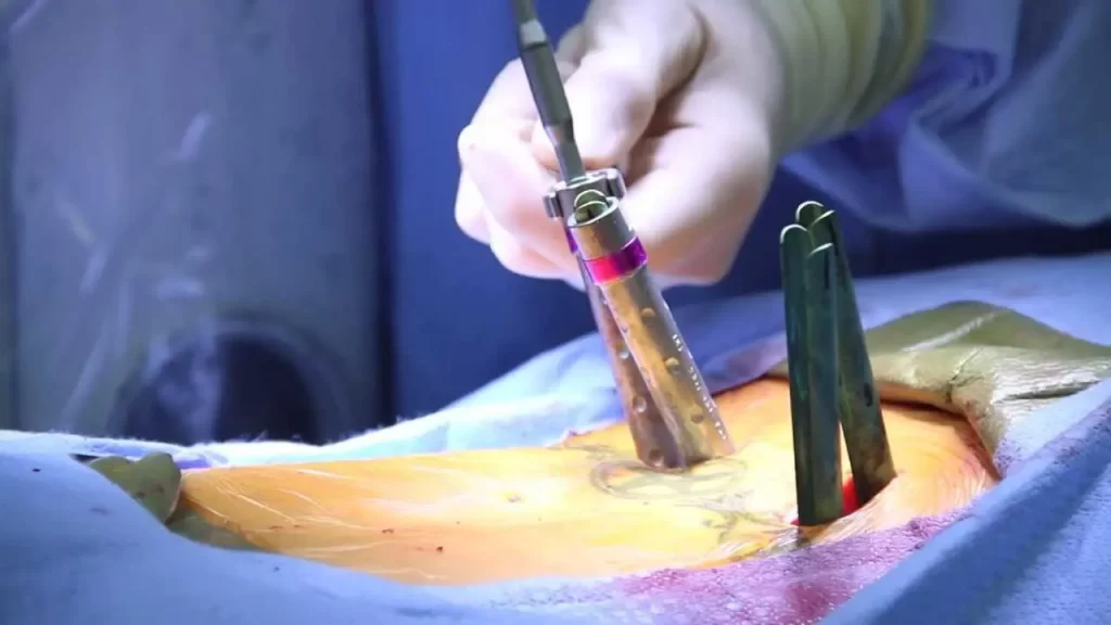 Minimally invasive spine surgery in Mumbai including MIS-TLIF and lumbar decompression by Dr. Vishal Kundnani