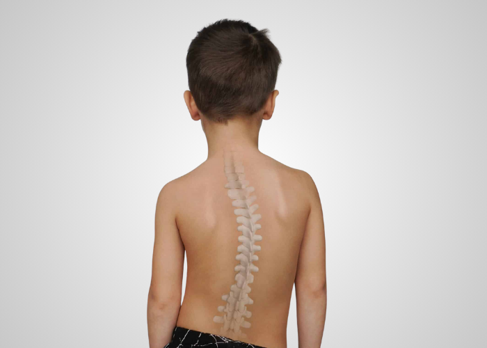 Scoliosis in Children and Teens