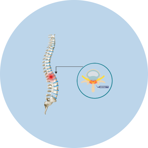 Lumbarisation & Sacralisation Treatment Icon
